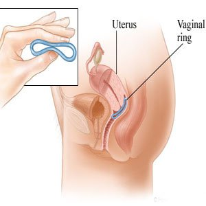 Vaginal Ring